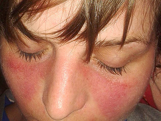 Не только от стыда могут появиться красные пятна на щеках молодых женщин -  МК