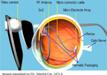 Врачи впервые в истории пациенту вставили бионический глазной протез