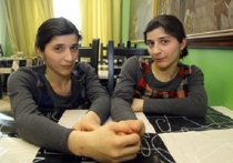 Сиамский близнец Зита Резаханова умерла после тяжелой болезни