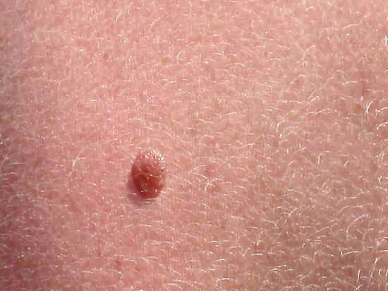 Какие пигментные образования на коже могут привести к меланоме
