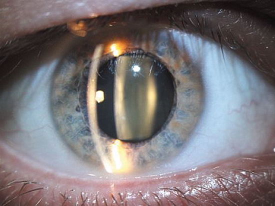 70% людей старше 60 лет страдают от катаракты