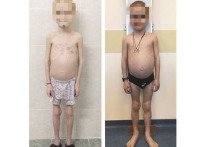 В конце марта в Москву на лечение из Магадана поступил сильно истощенный мальчик — в свои 11 лет он весил всего 11 килограммов при норме от 32
