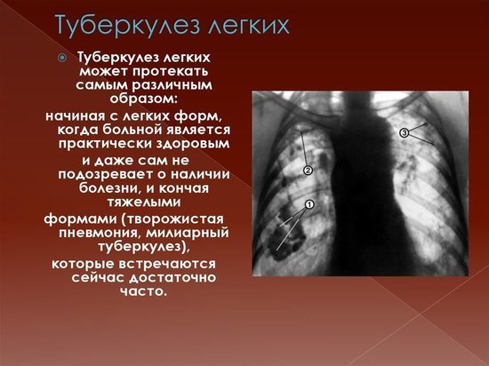 В Калужской области отмечен рост смертности от туберкулеза 
