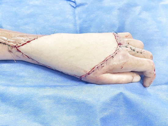 Пациенту с огромным дефектом конечности пересадили кожу с бедра
