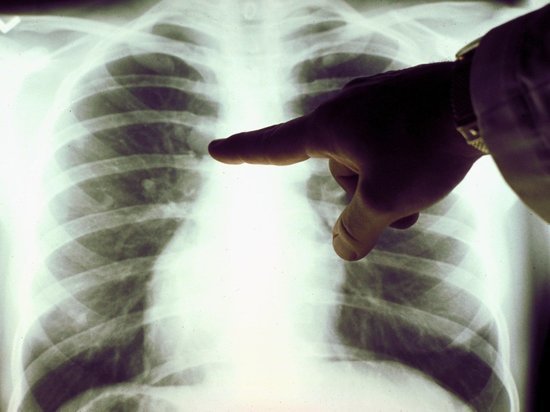 В Тверской области больную туберкулёзом школьную медсестру на бумаге делали здоровой 