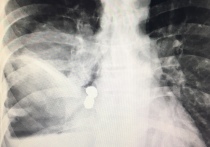 «Потерявшуюся» в бронхах зубную коронку смогли обнаружить и удалить у пациента московские хирурги