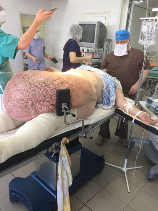 Ульяновские врачи удалили у женщины жировой «фартук» весом 60 килограмм