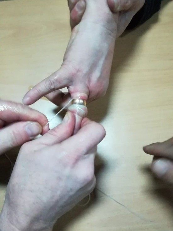 Растительное масло помогло спасателям снять кольцо с  распухшего пальца жительницы Тувы