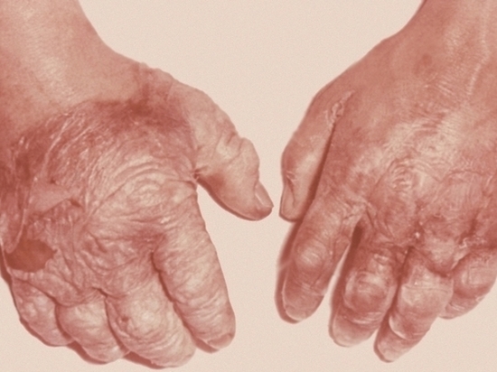 В Сорочинском районе 85-летняя бабушка отморозила руки