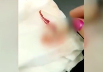 В сети появилось видео, на котором медработник больницы Надыма демонстрирует оторванный палец женщины, после чего восклицает, что «как это можно было так обкуриться», чтобы «оторвать себе палец»