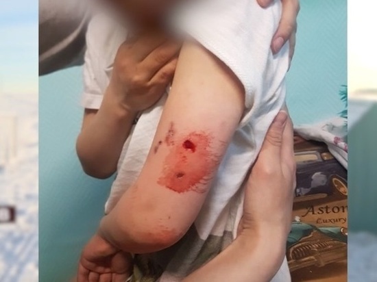Собака прокусила руку пятилетнему мальчику в Яр-Сале