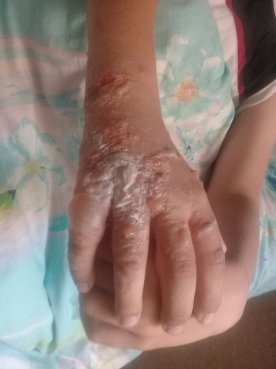 В Немане ребенок получил химический ожог от ядовитого растения