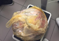 Опухоль яичника весом 25 кг и размером с огромный арбуз удалили у пациентки московские хирурги