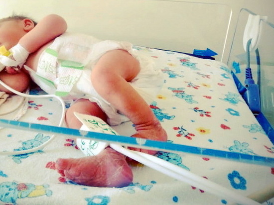 Пуповина завязана узлом: как ступинские врачи спасали новорожденную из Ясногорска