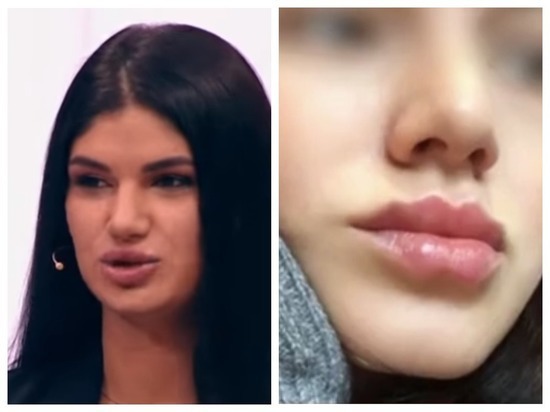 Жертва новосибирского косметолога-самоучки выступила на телешоу
