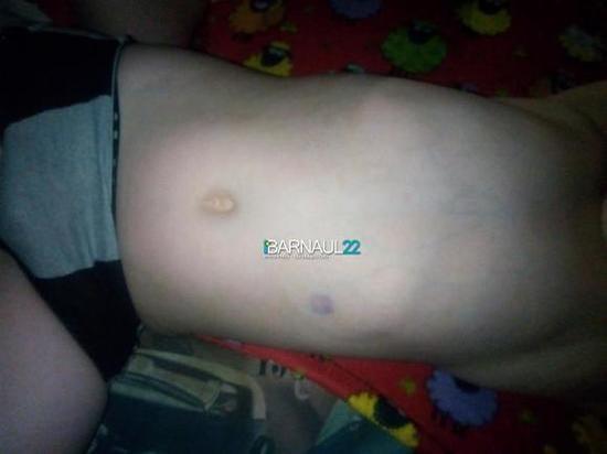 Домашний алабай покусал ребенка в Барнауле