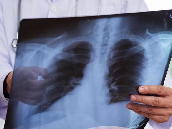 За два месяца пневмонией заболело более 840 жителей Томской области