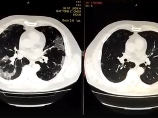 Врач показал «злую» пневмонию COVID-19 у пациента в Забайкалье