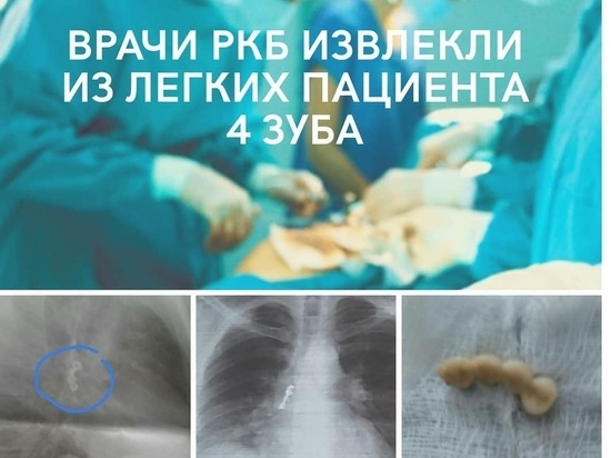 Дагестанские врачи извлекли из легких пациента 4 зуба