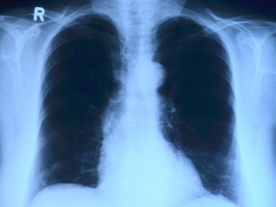 Зачастую первые симптомы не связаны дыхательной системой