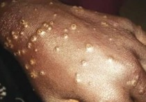 200 человек в Сенегале подхватили загадочную болезнь, которая на фоне пандемии коронавируса очень напугала наблюдаталей