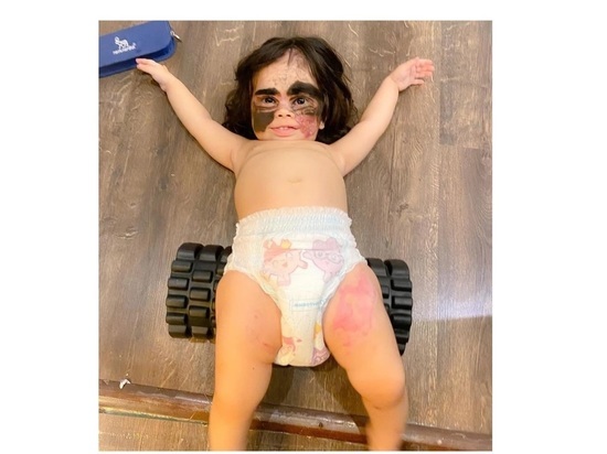Семья прооперированной в Краснодаре девочки Луны с пятном на лице показала новое фото ребенка