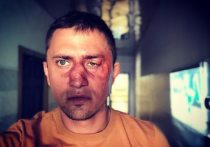 После этого Павел Прилучный был вынужден обратиться в больницу – он предпочел одну из московских клиник, где ему провели операцию на челюсти