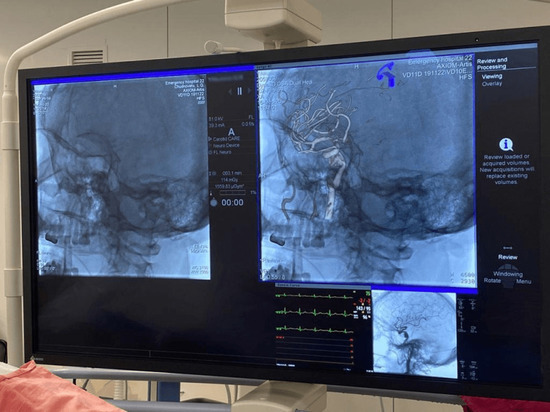 Врачи больницы скорой медпомощи в Уфе провели уникальную операцию на сосудах
