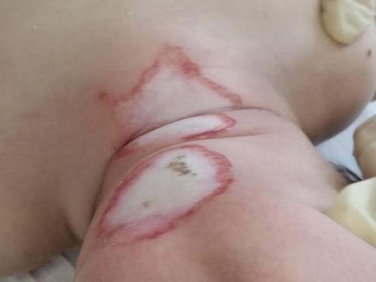 11-месячного малыша госпитализировали, ему предстоит пересадка кожи