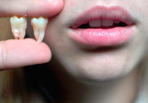 Зубы мудрости, они же пресловутые восьмерки, — самые неоднозначные в зубном ряду