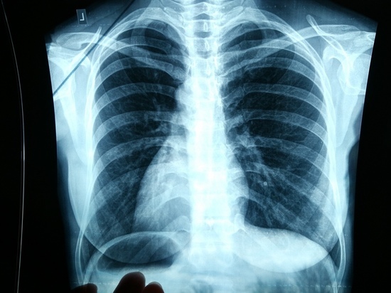 В Калмыкии можно будет бесплатно сделать рентген легких