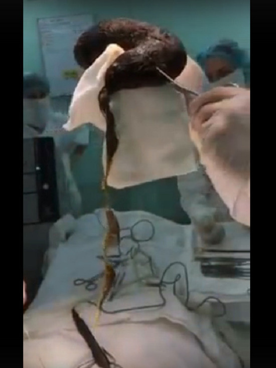 Челябинские хирурги удалили из желудка девочки килограммовый комок волос