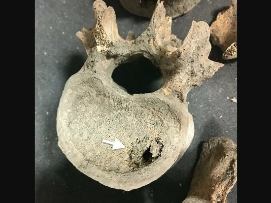 Кембридж: жители средневековой Англии аномально часто страдали от опухолей