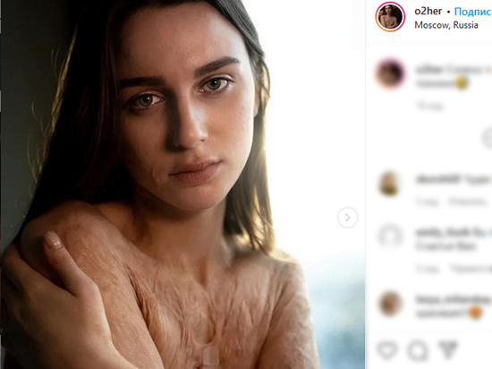 Девушка, обгоревшая в детстве и побывавшая в детском доме, стала фотомоделью