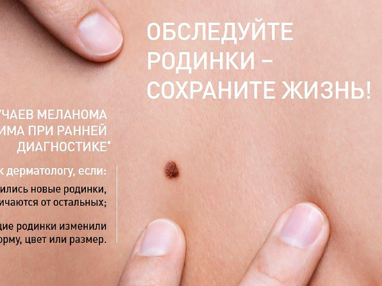 Белгородцев приглашают пройти обследование в рамках Всемирного дня диагностики меланомы