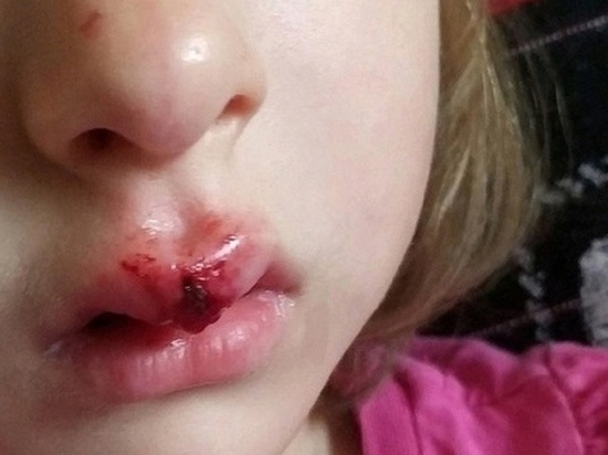 В Челябинске пятилетняя девочка разбила лицо, катаясь на самокате