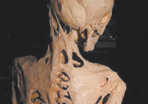 «Болезнь второго скелета» — так называют чрезвычайно редкое генетическое заболевание со сложным названием фибродисплазия оссифицирующая прогрессирующая (ФОП)