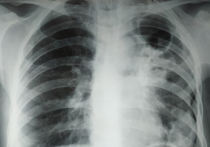 Туберкулёз — заболевание старое, если не сказать древнее