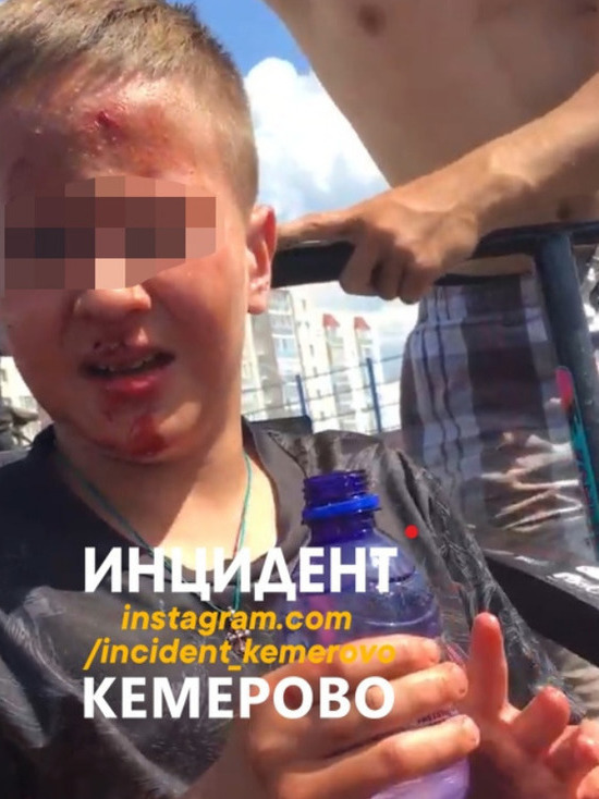 Ребенок разбил лицо во время катания на опасной кемеровской скейт-площадке