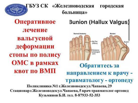 В больнице Железноводска оперируют вальгусную деформацию пальца стопы