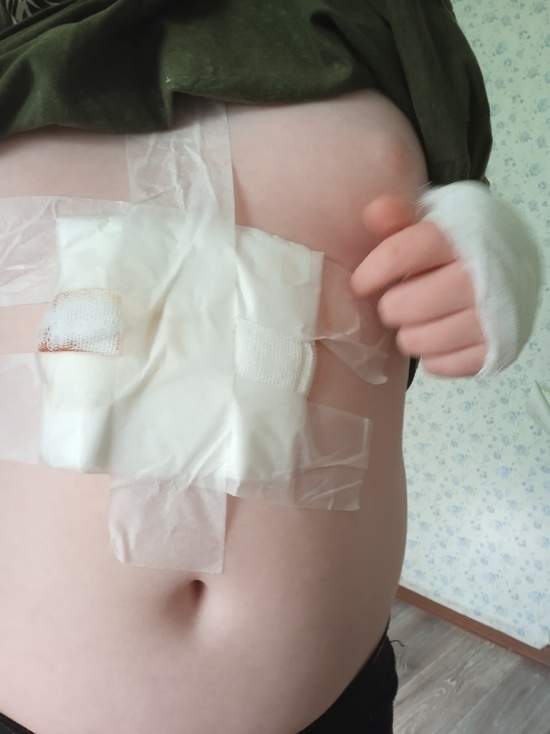 Рваные раны: чипированная собака искусала ребенка в Лабытнанги