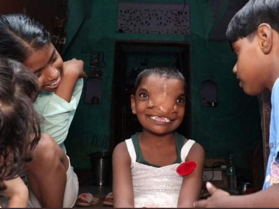 В Индии девочку с двумя носами признали воплощением божества