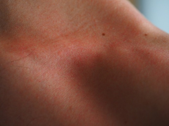 Дерматолог опровергла миф о связи заболеваний кожи с питанием