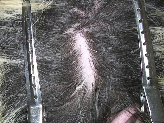 После визита к парикмахеру-садисту московскому школьнику потребовалась пересадка волос