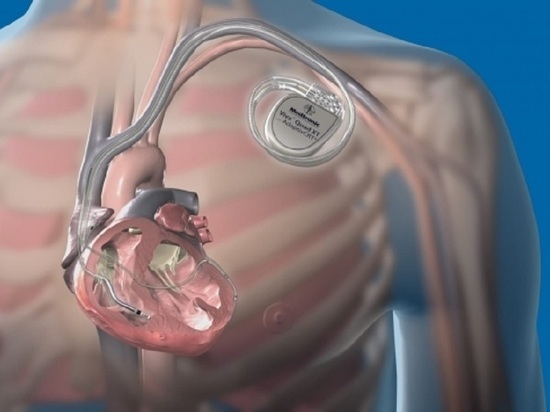 Сердечникам Колымы внедряют дефибрилляторы: прибор может вернуть к жизни