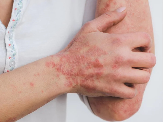Какие препараты могут вызвать неизлечимое заболевание кожи