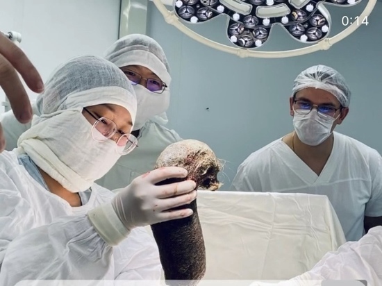 В Улан-Удэ из желудка ребенка хирурги извлекли огромный волосяной клубок