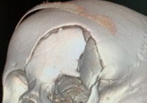 В Кузбассе дети разбили себе черепа при катании с горки