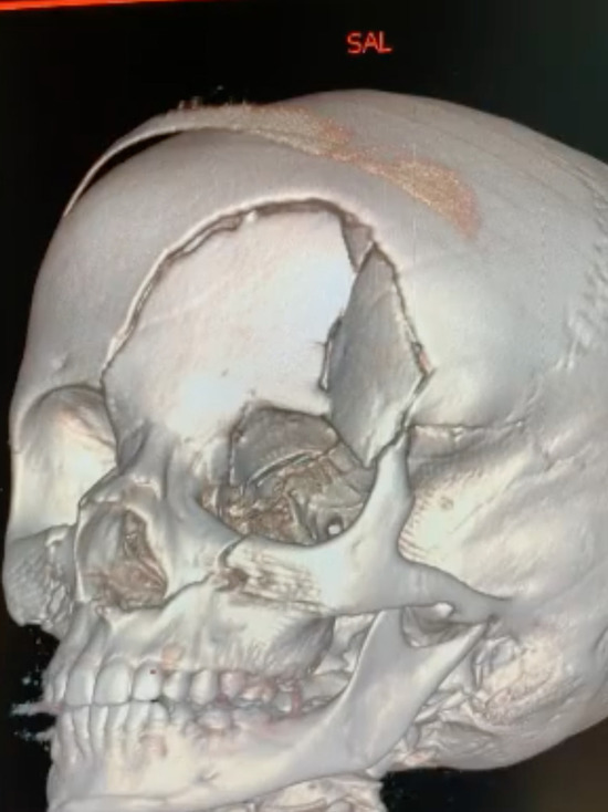 В Кузбассе дети разбили себе черепа при катании с горки