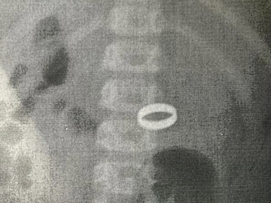 В Туапсе хирурги извлекли кольцо из желудка 2-летней девочки